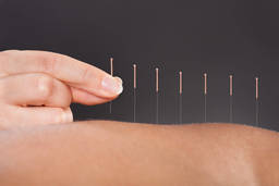 A beginner’s guide to the benefits of Acupuncture