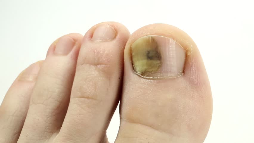 Types of nail fungi and how to spot them