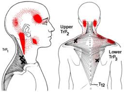 Muscles causing mid back pain - Trapezius - Dr Gert Ferreira - Chiropractor in  Centurion