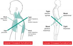 Back pain - Postural syndrome - Dr Gert Ferreira - Chiropractor in Centurion