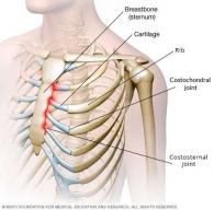 Back pain - Costochondritis - Chiropractor Centurion