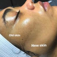 Is Dermaplaning Safe for All Skin Types? A Guide to Skin Suitability