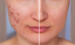 Top 5 Breakthrough Acne Scar Treatments of 2024