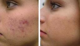 Understanding Acne Skin Peels: How They Work and What to Expect