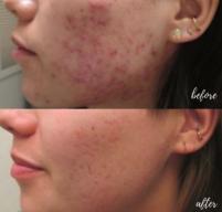 Breaking Down the Types of Acne Scars: How to Choose the Right Treatment