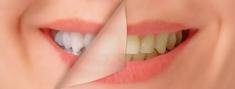 Tuesday and Thursday Laser Teeth Whitening Wierdapark Dentists 4 _small