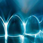 Tuesday and Thursday Laser Teeth Whitening Wierdapark Dentists 3 _small