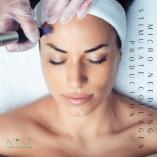 Get 20% OFF all Microneedling treatments, add on an LED treatment Northcliff Botox 7 _small