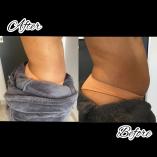 Fat Freeze, Cellulite and Varicose veins Northcliff Botox 3 _small