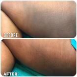 Brightening with Glutathione and/or Stretch marks treatment Northcliff Botox 4 _small
