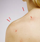 Acupuncture