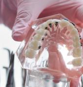 Types of dental braces