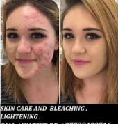 Permanent Skin Lightening Skin Whitening Products Reiger Park Skincare Products 1_small