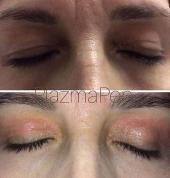 Plasma Pen Upper Eyelid Tightening & Lifting Treatment