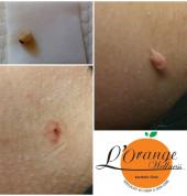 Skin Tag and Lesion Removal