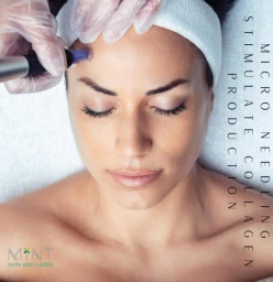 Get 20% OFF all Microneedling treatments, add on an LED treatment Northcliff Botox