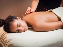 Acupuncture