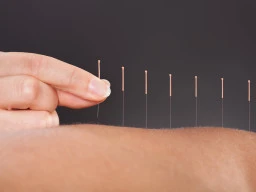 A beginner’s guide to the benefits of Acupuncture