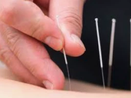 Acupuncture