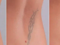 The Science of Tattoo Removal: How Laser Technology Works to Erase Ink