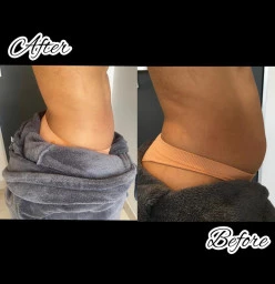 Fat Freeze, Cellulite and Varicose veins Northcliff Botox