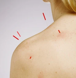 Acupuncture