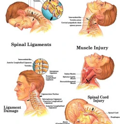 Mechanism of Whiplash injury