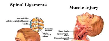 Mechanism of Whiplash injury