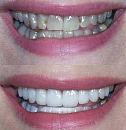Crowns, Dentures